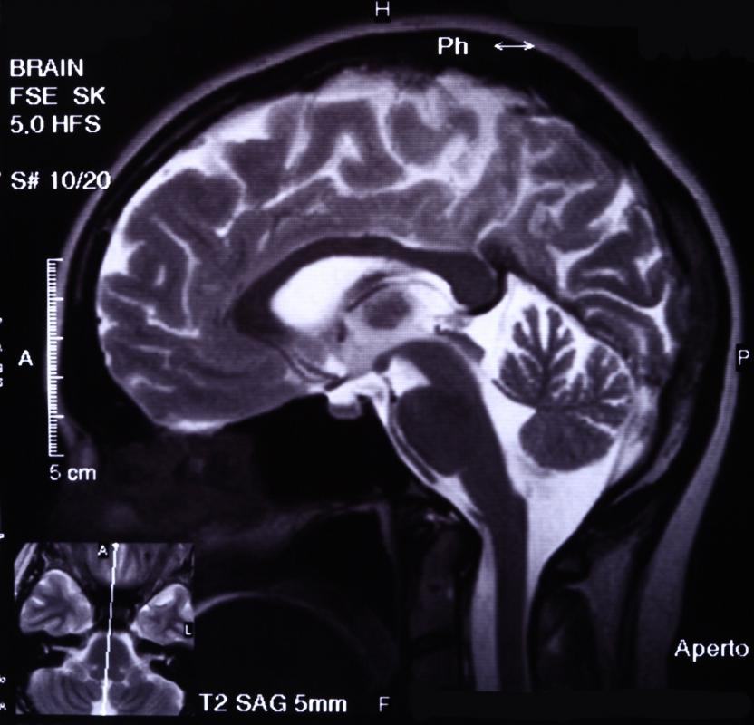 Neuroimaging can be used to diagnose a number of brain and central nervous system issues, as well as to assist with treatment.