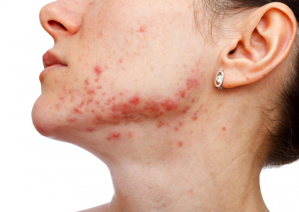 A skin care specialist can treat acne.