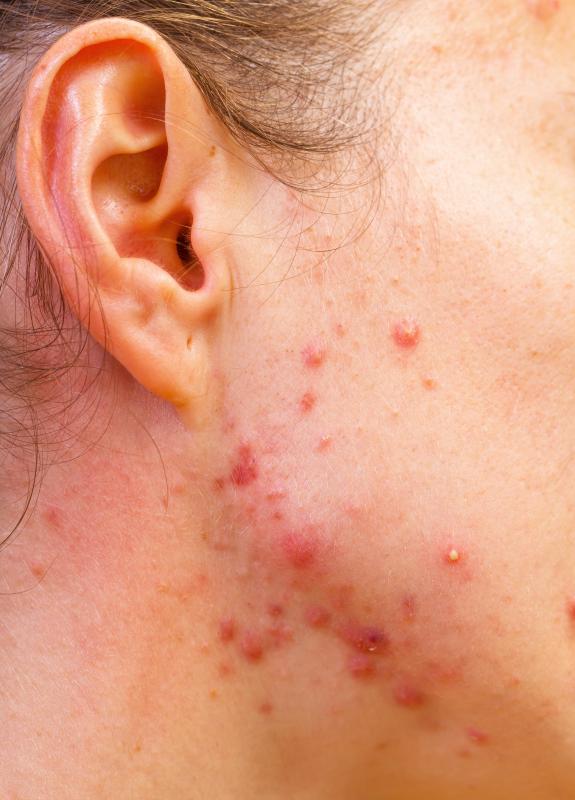 Some skin doctors focus on treating conditions such as acne.