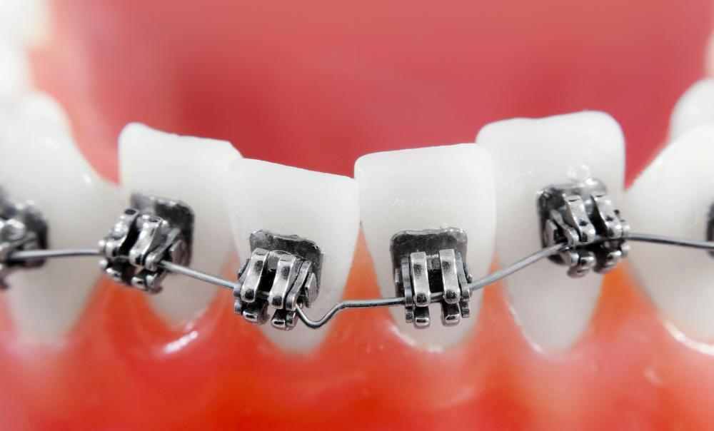 Orthodontists rank among the top ten highest paid professionals worldwide.