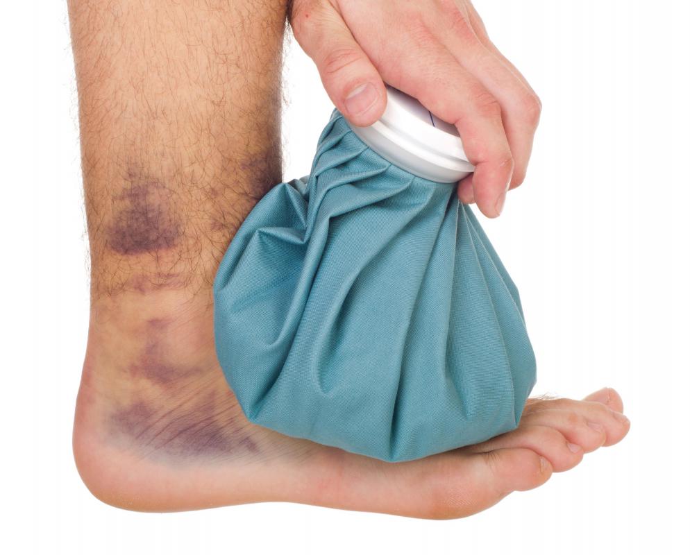 A man with a sprained ankle.