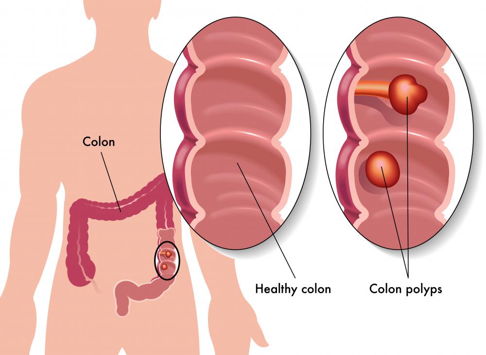 Gastroenterologists often treat common ailments, such as colon polyps.