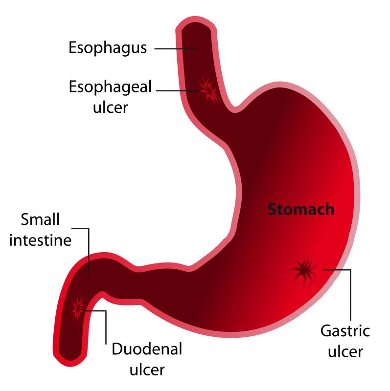 An internal medicine specialist may be called upon to treat an ulcer.