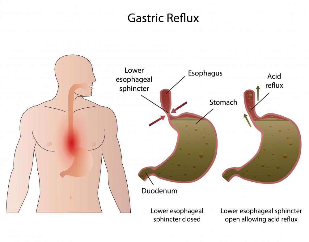 A cardiovascular thoracic surgeon may concentrate on the damage caused by gastroesphageal reflux.
