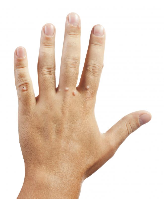 Some skin care specialists may help individuals who want to treat warts.