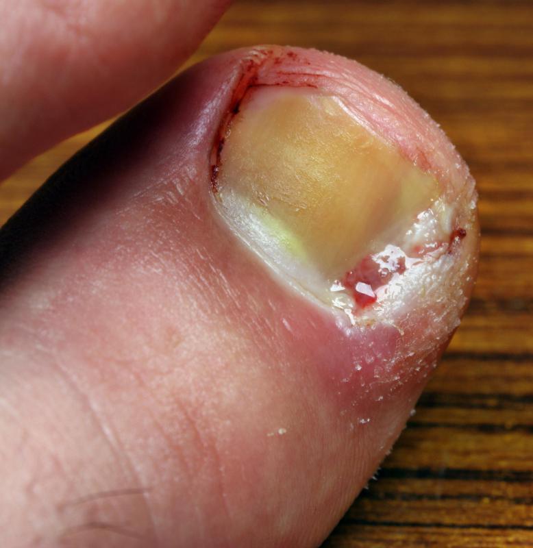 A podiatrist may deal with painful irritations such as an ingrown toenail.