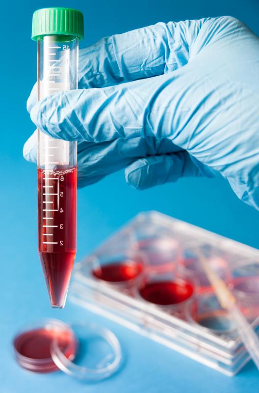 A patient's physician may draw a blood sample for assessment by a hematopathologist.