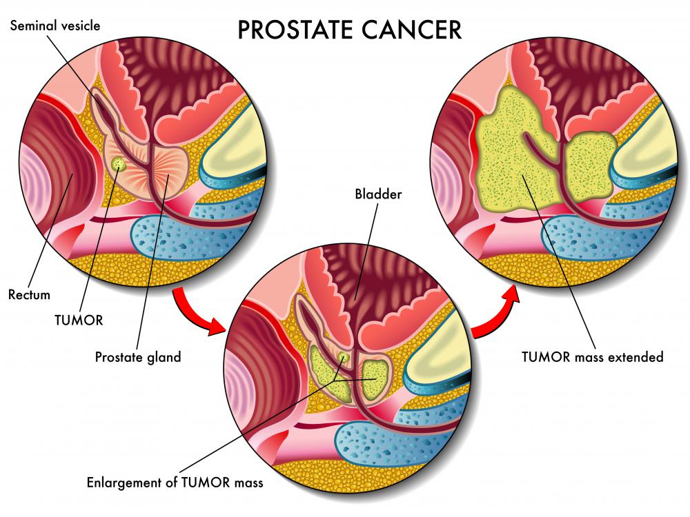 Brachytherapy is a form of radiotherapy that may be used to treat prostate cancer.