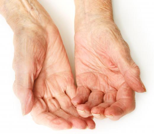 Clinical immunologists treat autoimmune conditions, such rheumatoid arthritis.