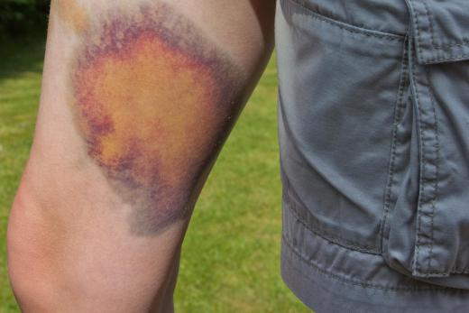 Bruises should be expected when becoming a student at a pro wrestling school.