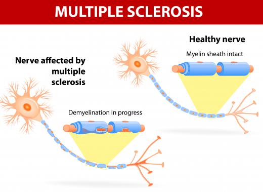Neurology consultants may deal with patients who have multiple sclerosis.