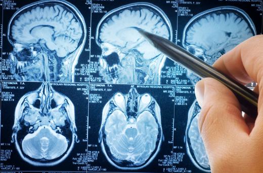 The study of neurology includes diseases of the brain such as brain cancer.