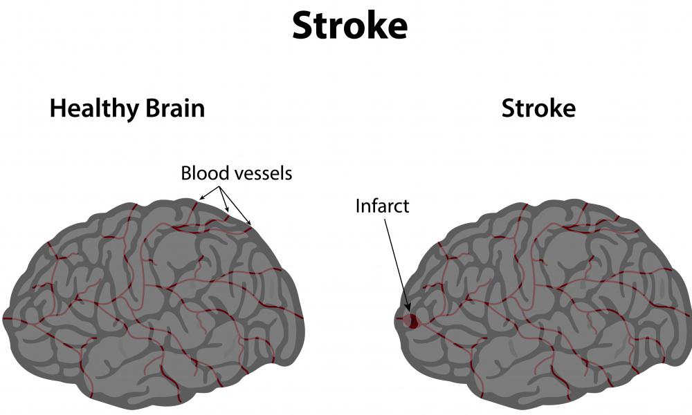 An interventional neurologist may be able to treat a stroke while it's happening.