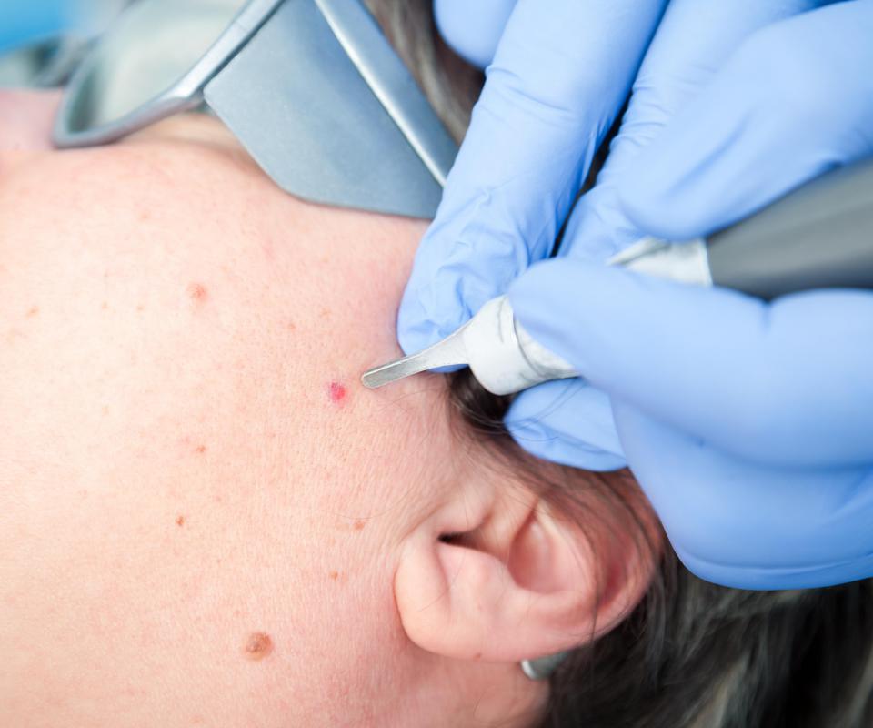 Cosmetic dermatologists typically offer laser surgery to remove birthmarks or scars.