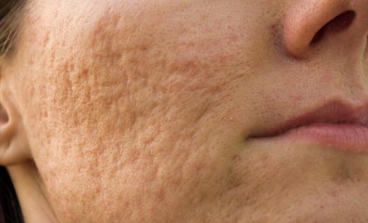 An acne specialist can prevent or treat permanent tissue scarring.