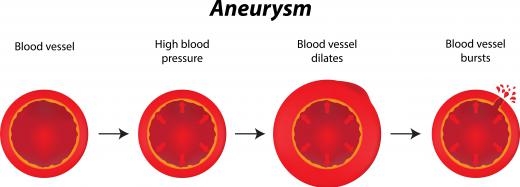 An aneurysm can be treated by an interventional neurologist.