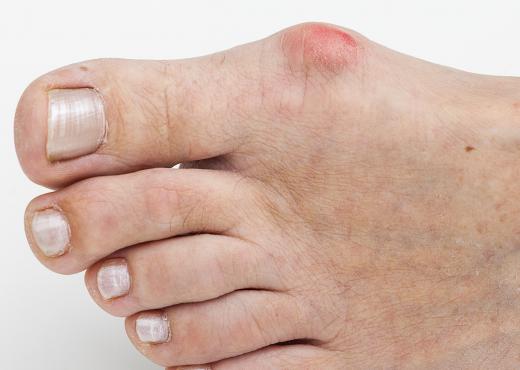 Podiatry can include the treatment of bunions.