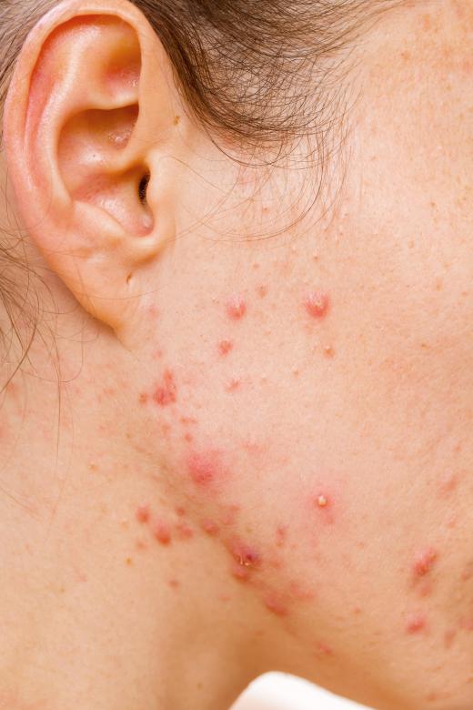 Dermatologists may focus on people who have acne and related skin conditions.