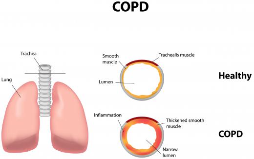 Patients with COPD and other breathing ailments may need a physiologist.