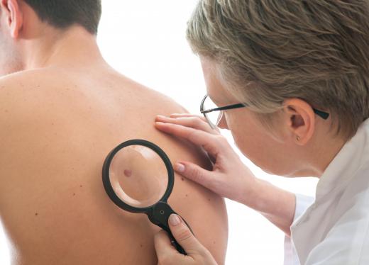 A dermatologist examining a mole.