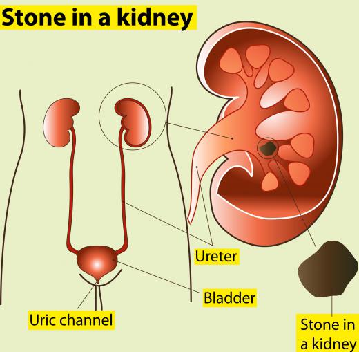 One abnormality that an ultrasonographer may look for is kidney stones.