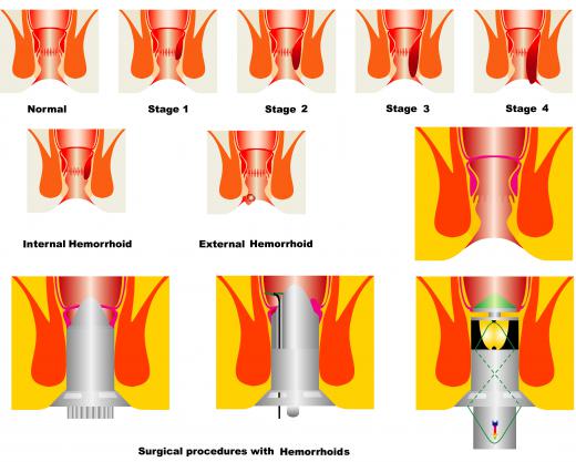 A proctologist may treat patients suffering from hemorrhoids.