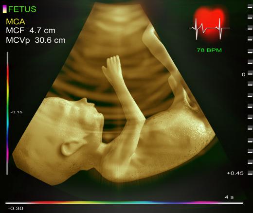 Sonograms can be taken to produce 3D images.