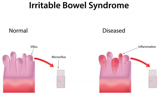 Hypnotherapy may be beneficial in treating irritable bowel syndrome.