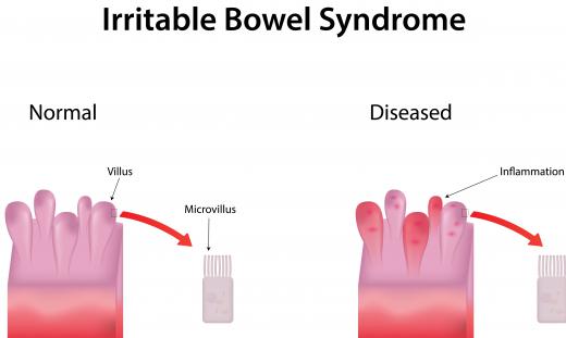 Irritable bowel syndrome is one condition that a gastrologist may treat.