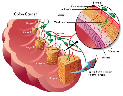 A proctologist should be educated about diagnosing and treating colon cancer.