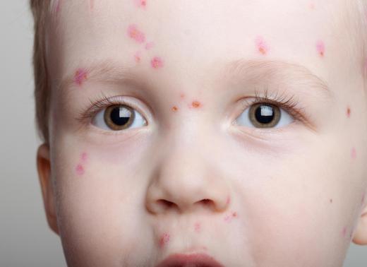 Immunodermatologists often focus on skin illnesses like chicken pox.