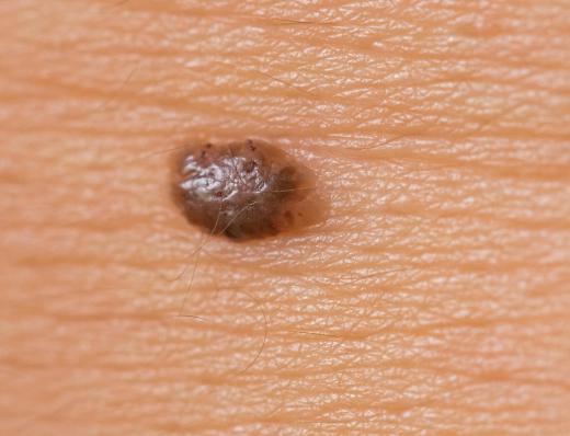 Some dermatologists specialize in moles and other skin lesions that might be cancerous.