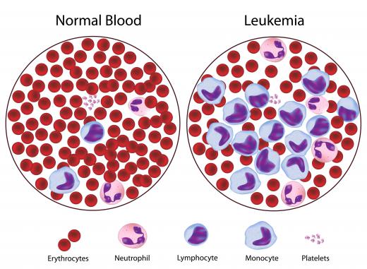 A diagram of the effects of leukemia, one of the most common pediatric cancers.