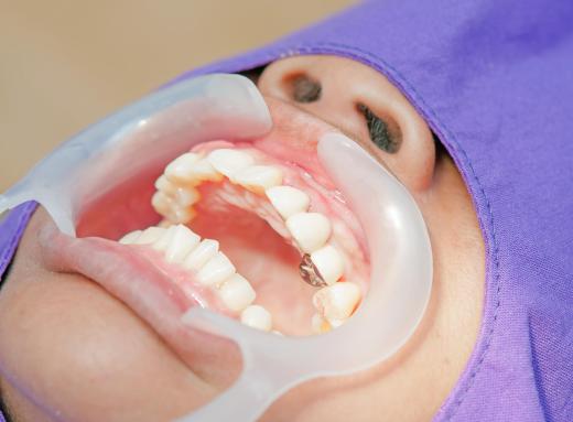 Cosmetic dentists may take special courses to master the latest teeth bleaching or whitening procedures.