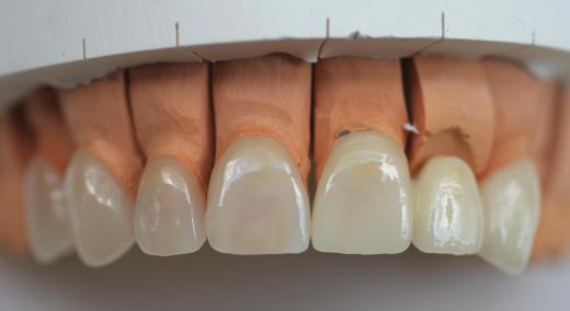 A dental technician may choose to focus on creating permanent prostheses like porcelain veneers.