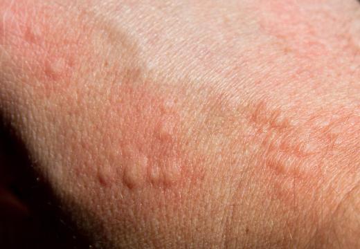 An individual with hives could go see an allergy immunologist.