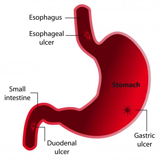 A gastrolgist may be involved in the treatment of ulcers.