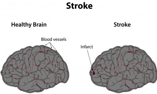 An interventional neurologist may be able to treat a stroke while it's happening.