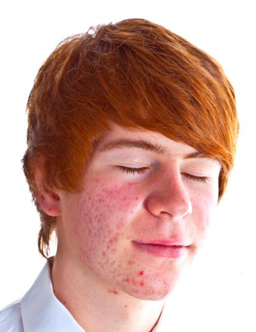 A boy with acne.