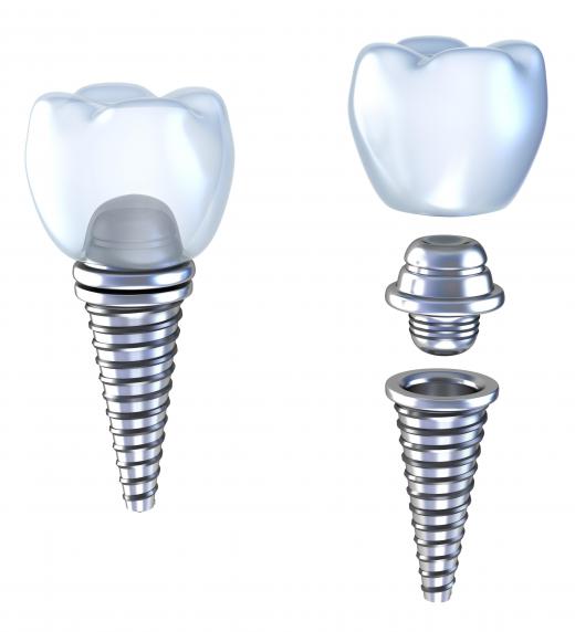 An illustration of a dental implant with a titanium abutment.